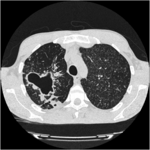 London Advanced TB Course