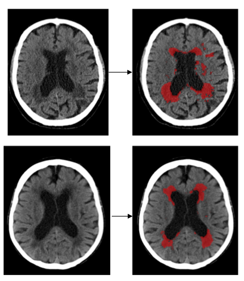 CT scan