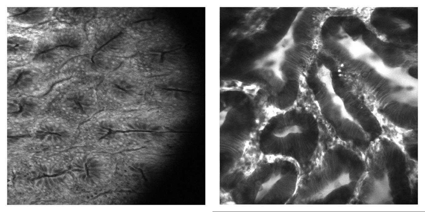 Images of polyps in the colon recorded using a fluorescence endomicroscope.