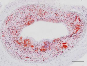 An atherosclerotic plaque full of aggregates of fatty particles, stained in red. 