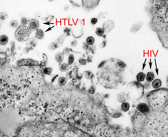 Image showing the presence of both HTLV-1 and HIV